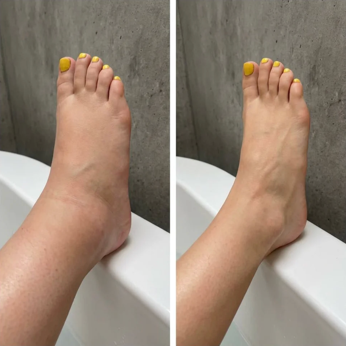 DRENAGGIO LINFATICO